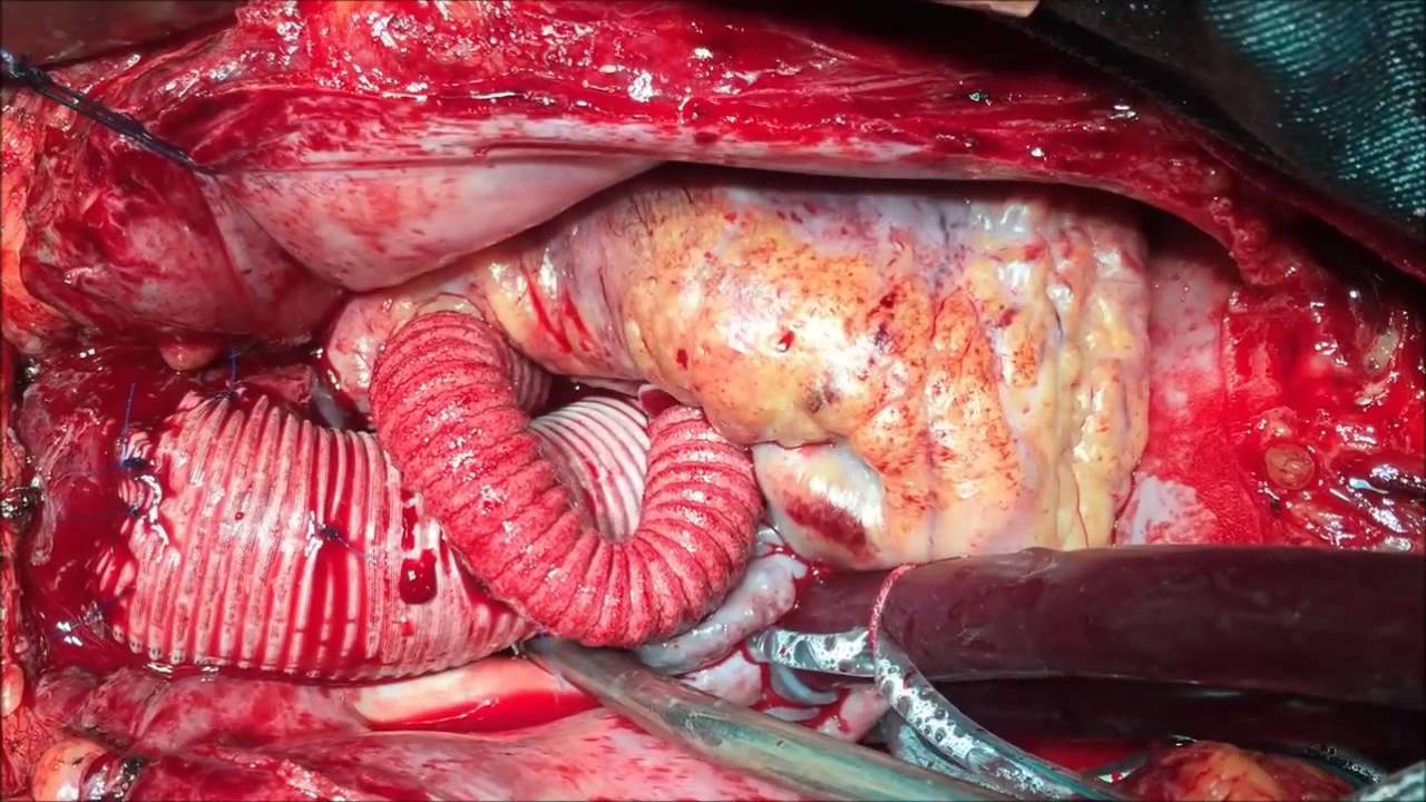 Portal do Médico - Cirurgia de Aorta