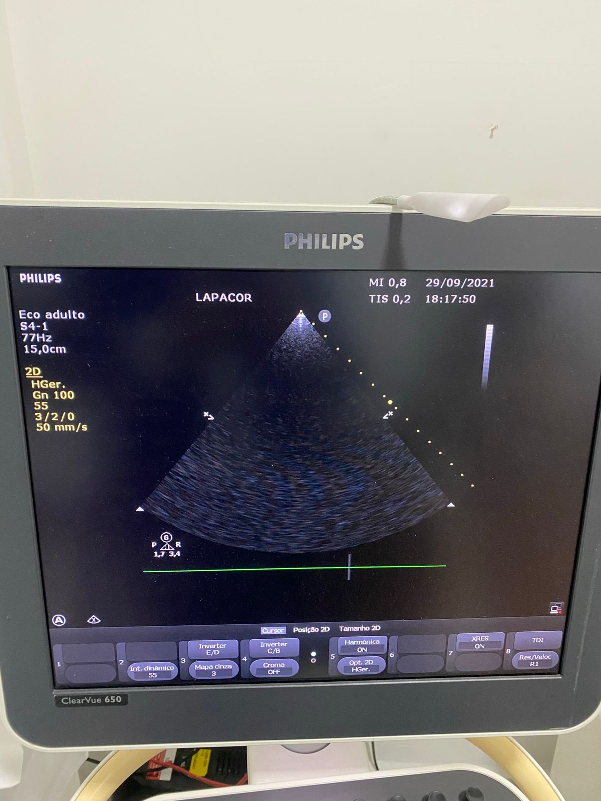 Philips - ClearVue 650 Ultrassom